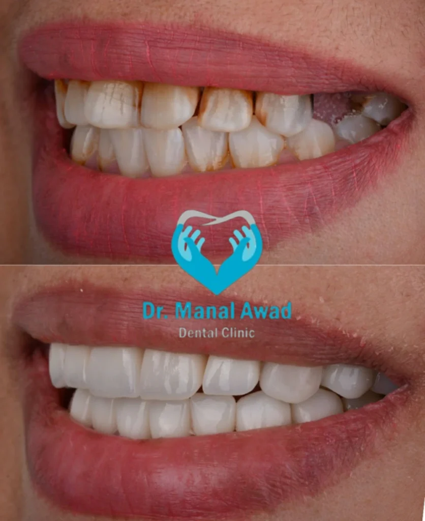 Cosmatic dentistry In Jordan 5