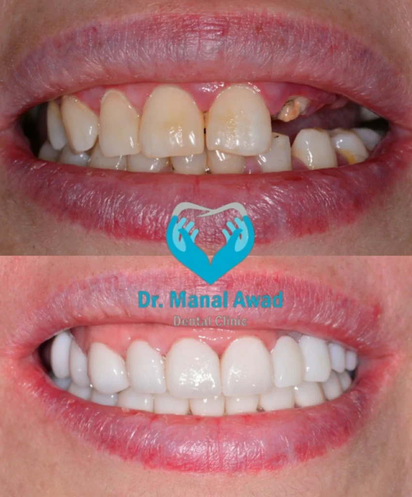 Dental Implant In Jordan 4