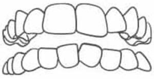 Crowded-Teeth-300x154